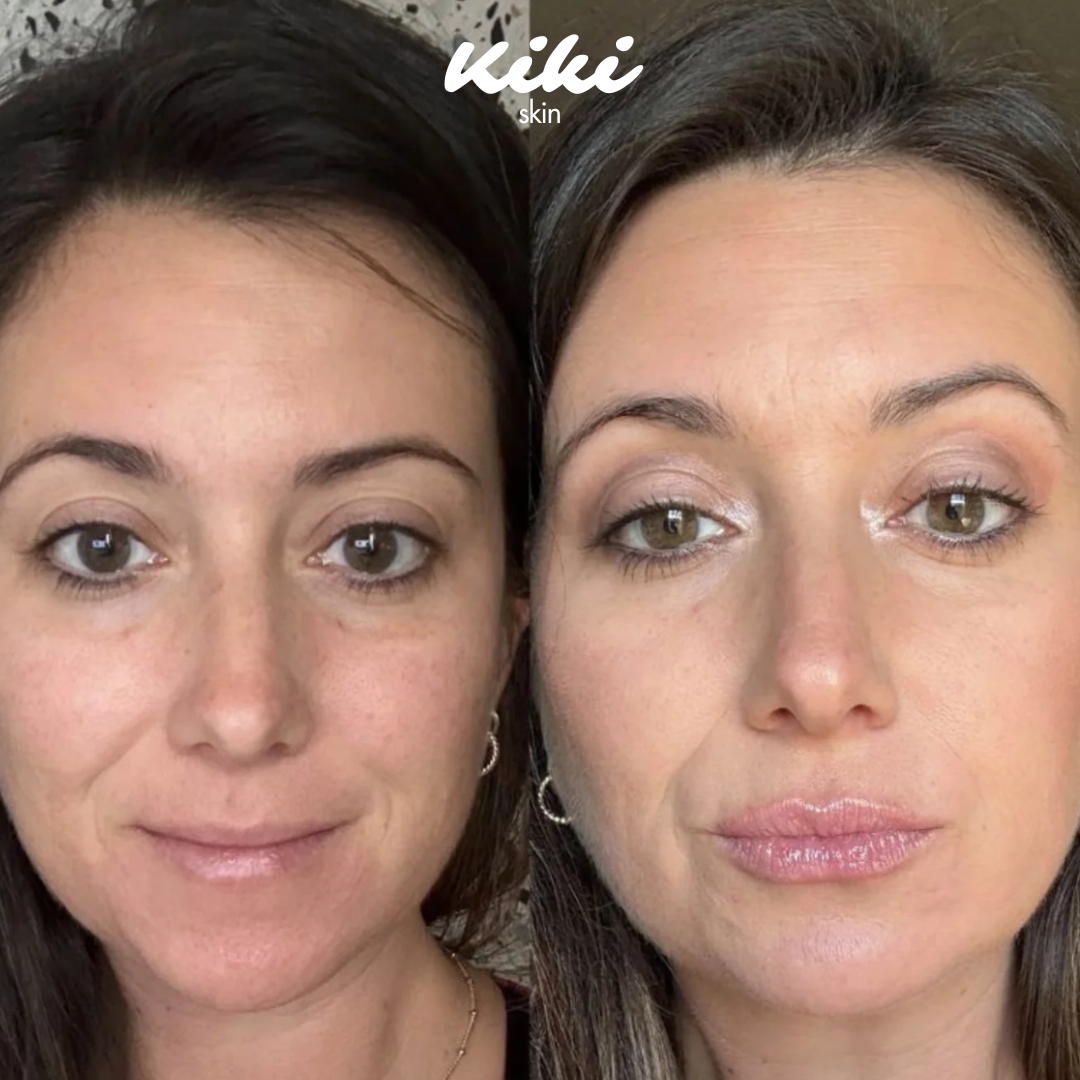 LipBoost - Kit Volume & Idratazione Labbra✨